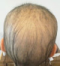 CG428 Chemoterapy Hair loss